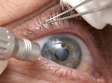 Отслоение сетчатки глаза - операция, стоимость